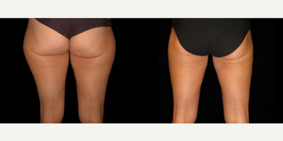 Liposuction before and after photo