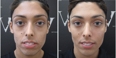Liquid Facelift before and after photo
