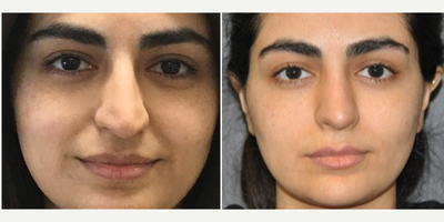 Rhinoplasty before and after photo