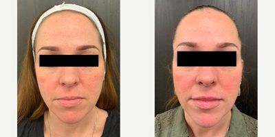 Volbella before and after photo