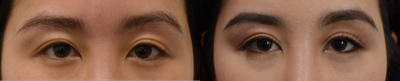 Double Eyelid Surgery before and after photo