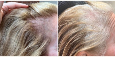 Hair Loss Treatment before and after photo