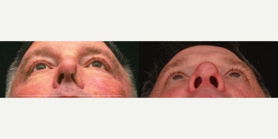 Septoplasty before and after photo