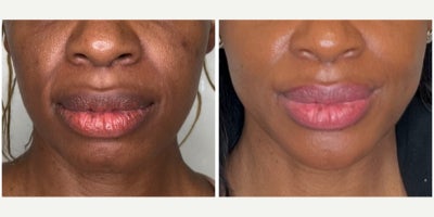 Dermal Fillers before and after photo