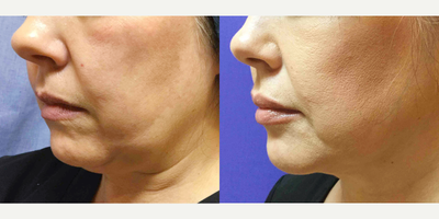Kybella before and after photo