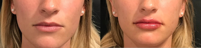Lip Fillers before and after photo