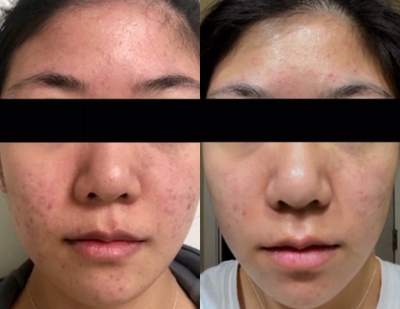 Microneedling RF before and after photo