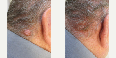 Mole Removal before and after photo
