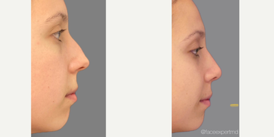 Rhinoplasty before and after photo