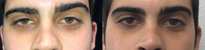 Brow Lift before and after photo