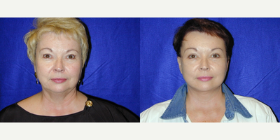 Facelift before and after photo