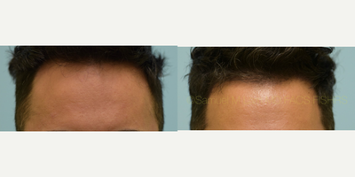 FUE Hair Transplant before and after photo