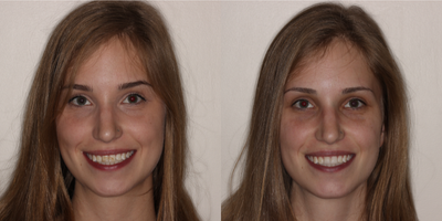 Porcelain Veneers before and after photo