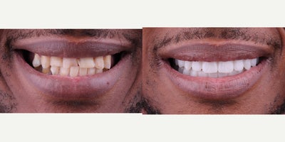 All-on-4 Dental Implants before and after photo