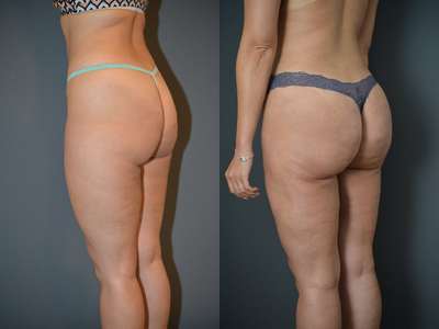 Brazilian Butt Lift before and after photo