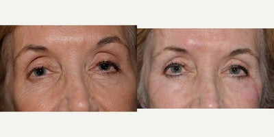 Chemical Peel before and after photo