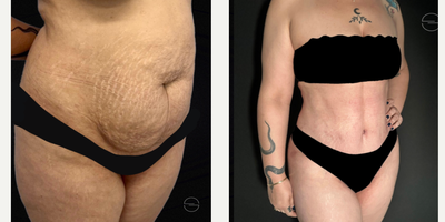 Mommy Makeover before and after photo