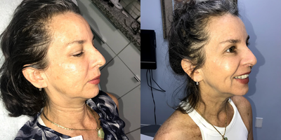 Chemical Peel before and after photo