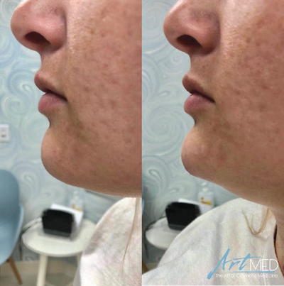 Chin Filler before and after photo