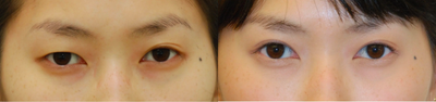 Double Eyelid Surgery before and after photo