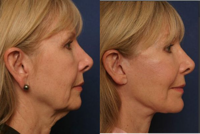 Facelift before and after photo