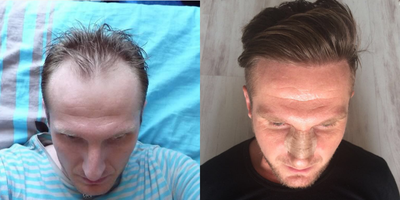 FUE Hair Transplant before and after photo