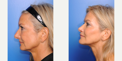 Genioplasty before and after photo