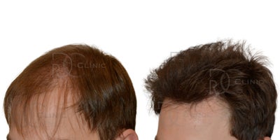 Hair Transplant before and after photo