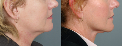 Neck Lift before and after photo