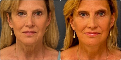 Neck Lift before and after photo