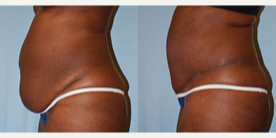 Tummy Tuck before and after photo