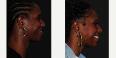 African American Rhinoplasty before and after photo