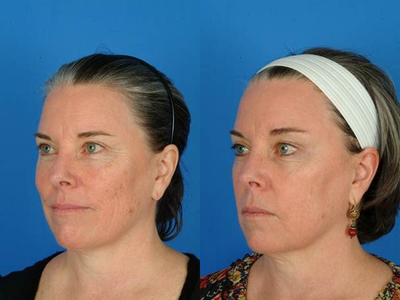 Fraxel Laser before and after photo