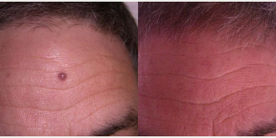 Mole Removal before and after photo