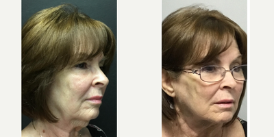 Thread Lift before and after photo
