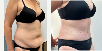 Tummy Tuck before and after photo