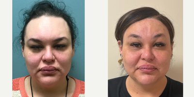 Brow Bone Reduction before and after photo