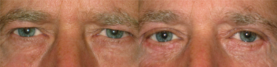 Eyelid Surgery before and after photo