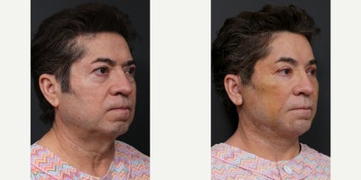 Facial Fat Transfer before and after photo