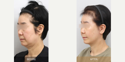 Liposuction before and after photo