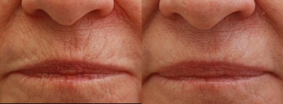 Botox before and after photo