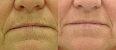 Chemical Peel before and after photo