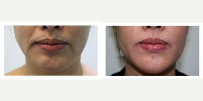 Dermal Fillers before and after photo
