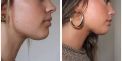 Dermal Fillers before and after photo