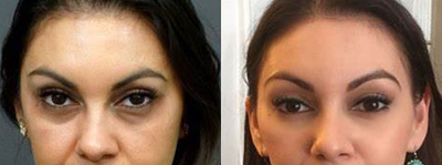 Eyelid Surgery before and after photo
