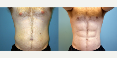 Abdominal Etching before and after photo