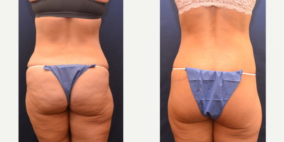 Body Lift before and after photo