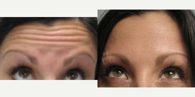 Botox before and after photo