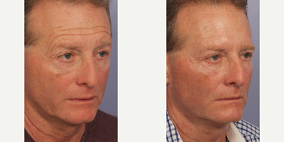 Botox before and after photo