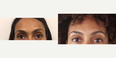 Dysport before and after photo